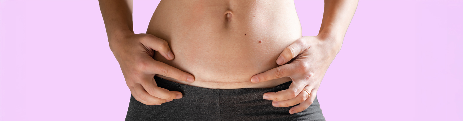 Caesarean Section Care