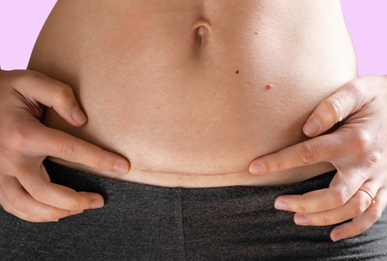 Caesarean Section Care